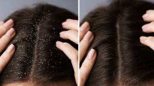 How to get rid of Dandruff Naturally